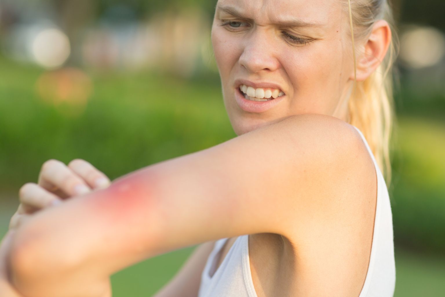 West Nile Virus trasmesso dalle zanzare: ecco cos e come si cura