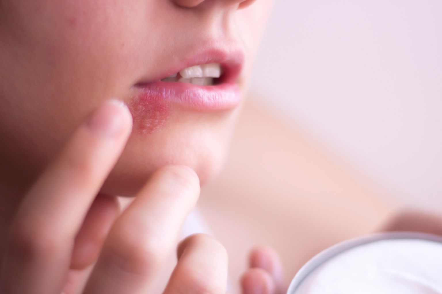 Herpes labiale: cause, sintomi e rimedi